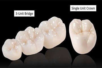 Crown and Bridge Treatment - Dr. Jinu's Dental Care in Edapally Kochi